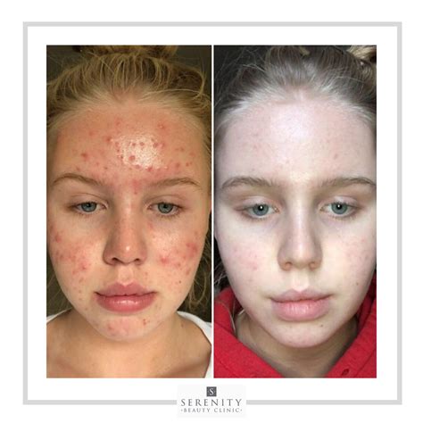 acne chemical face peel