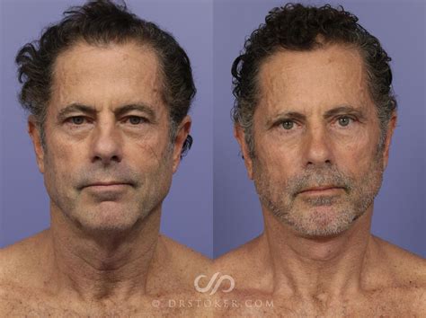 how to remove neck fat 8