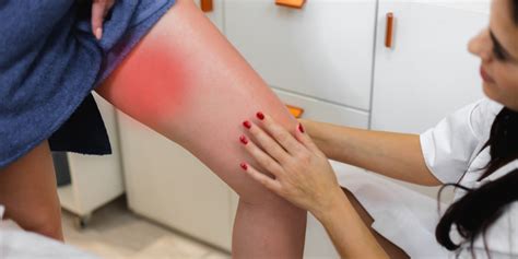 thigh chafing  symptoms  treatment