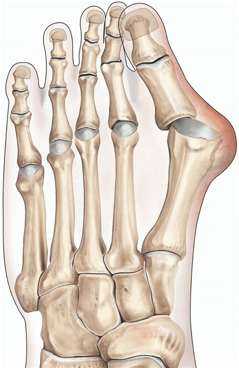 Bunion surgery | healthdirect