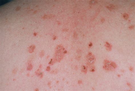 pemphigus vulgaris heilungsdauer ivrcqb