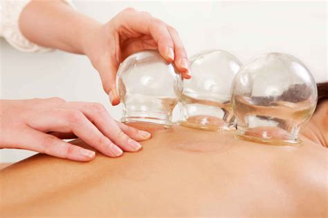 Cupping Therapy - Yan Acupuncture & Herbs - Gainesville, FL