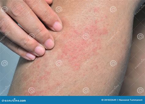 red allergic rash   leg skin  atopic dermatitis stock image