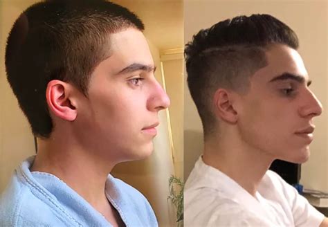 Mewing Before & After: 122+ Progress Photos (Male & Female Transformations)