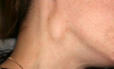 What Causes Swollen Lymph Nodes Neck