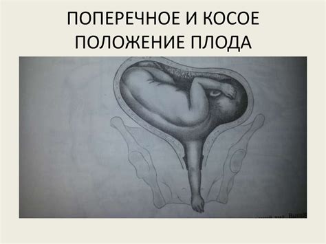Неправильные положения и разгибательные предлежания плода - презентация ...