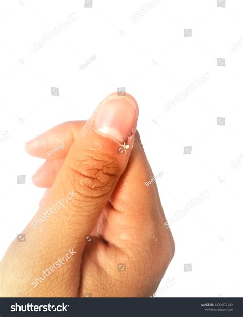 Excoriation Skinpicking Disorderpicking Skin Around Nails Stock Photo