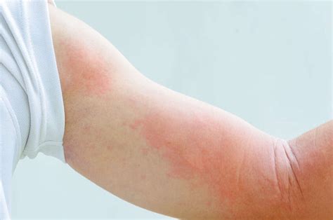Skin Rash: 10 Causes of Skin Rashes