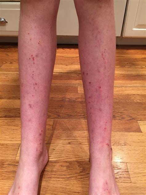 Parent's Speak Out About Allergic Contact Dermatitis and Patch Testing