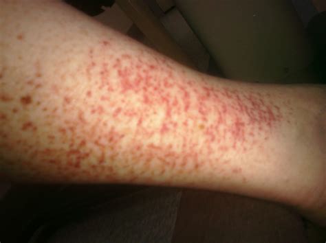 Petechiae Legs