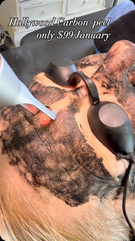 Unbelievable Blackhead Removal 2024: The Results Are Simply Astonishing! Image 20