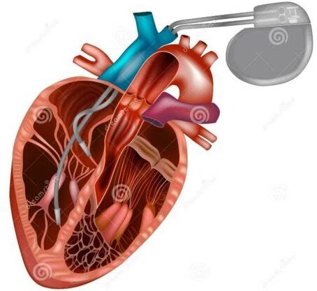 pacemaker heameda hospital