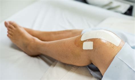 Total Knee Replacement Recovery: What to Expect After Knee Replacement