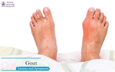 Symptoms Of Gout In Toes