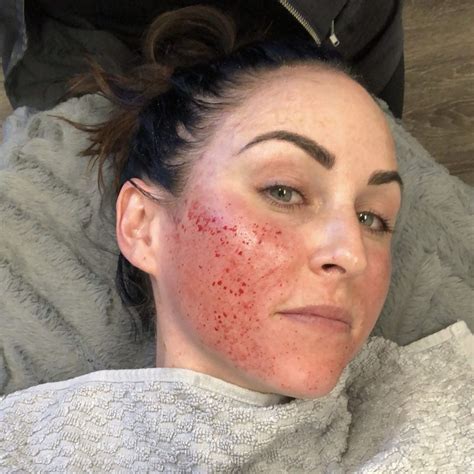 guide to microneedling | Glowday