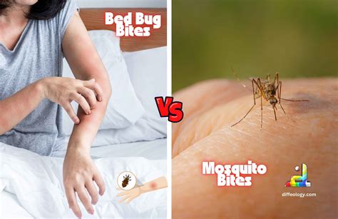 sand fly bites vs bed bugs 7