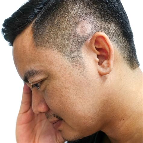lupus hair 11