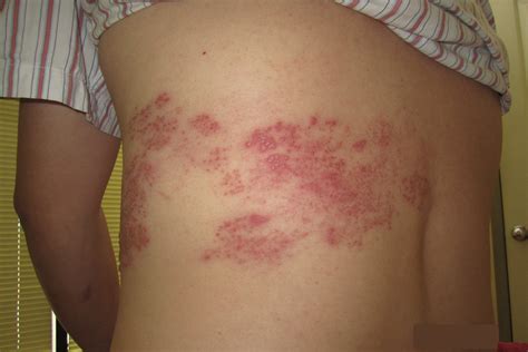 How Do Shingles Look When Healing at Eva Timmins blog