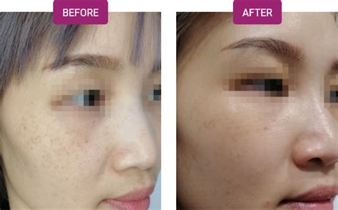 Pico Laser PROMO First Trial RM298