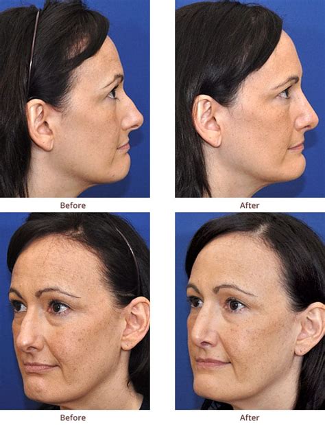 LIFE Before and After Photos | Rhinoplasty