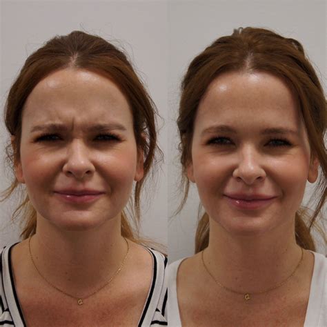 Treat Frown Lines & 11s with Botox at Esthetic Solutions