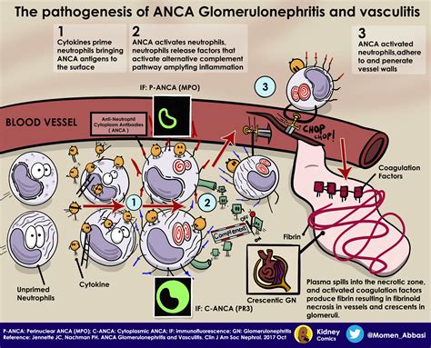Kidney Comics: The Pathogenesis of ANCA Associated Vasculitis - Renal