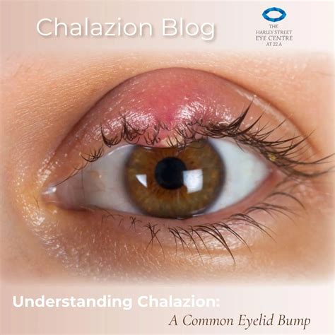 Understanding Chalazion: A Common Eyelid Bump