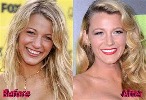 blake lively nose    gnndmg