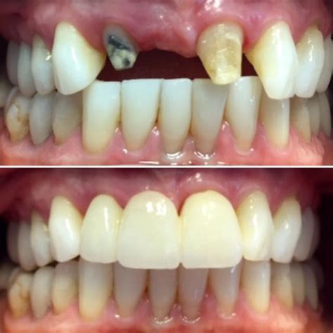 Dental Bridges Before And After