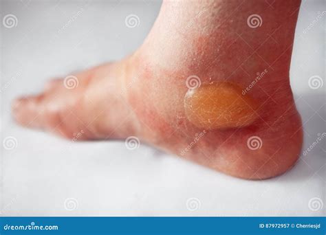 Huge Bruise On The Leg Of A Woman. A Bruised Leg. Close-up Stock Image ...