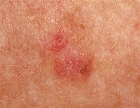 Keratosis Follicularis Scalp Recurrent corneal ulcerations with