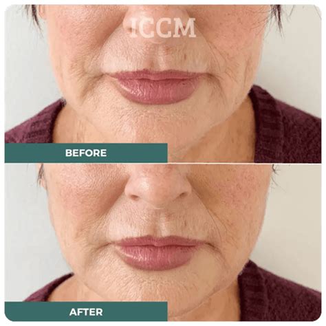 Thread Lift Recovery Time: What to Expect