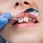 What Causes Buck Teeth and How Can They Be Safely Treated | Miracle Dental