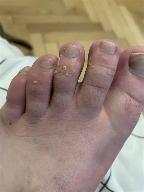What is with the dry/rough skin on my toes (both feet but much worse on