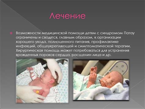 Синдром Патау - презентация онлайн