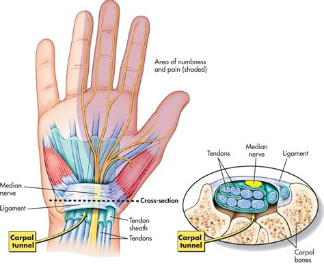 carpal tunnel syndrome