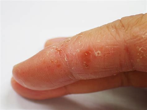 What Is Dyshidrotic Eczema? – Balmonds