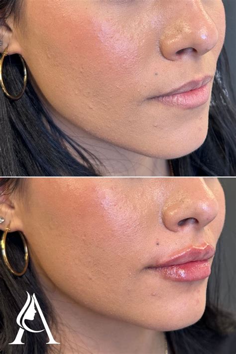 Philly Lip Filler | Lip fillers, Botox lips, Lip injections