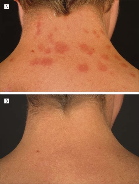 lupus skin rash  neck vrogueco