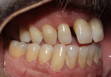 Case Gallery - ClearCorrect