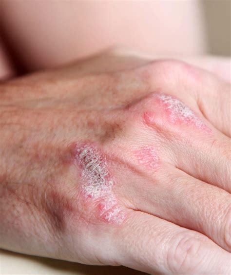 Psoriasis | RN-POST