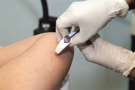 Implant Contraception
