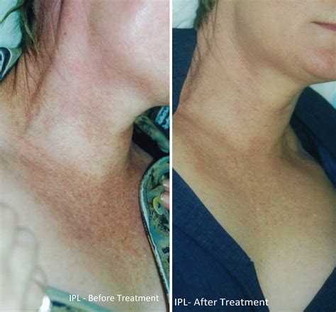 Intense Pulsed Light Before And After Photos – DFXDX