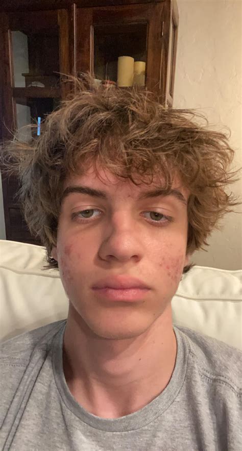 Accutane before and after : r/Accutane