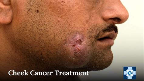 PPT - Advancements in Cheek Cancer Treatment Insights from GEIPE Cancer ...