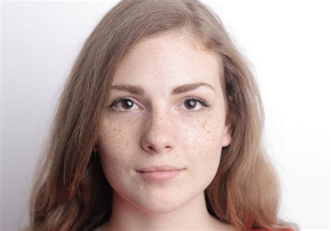 abbronzatura chiazze