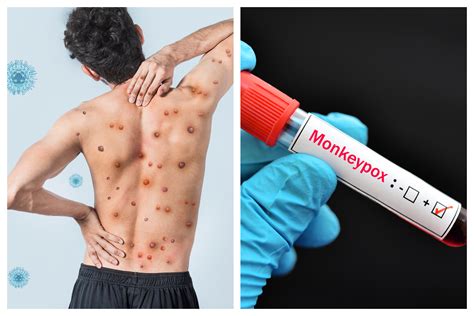 patient   strain  monkeypox hospitalized  uk newsweek