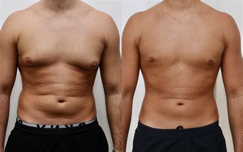 Weight Gain After Gynecomastia Surgery at Keith Flores blog