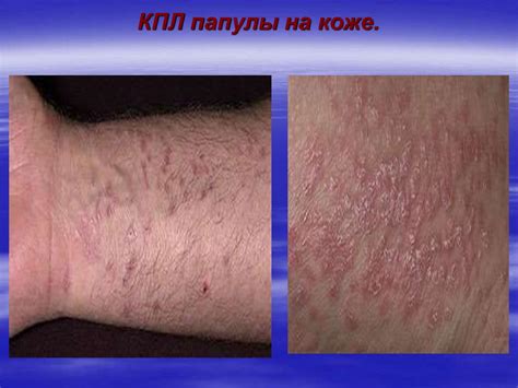 Красный плоский лишай - online presentation