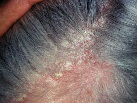 Seborrheic Dermatitis Symptoms Causes Treatments | The Best Porn Website